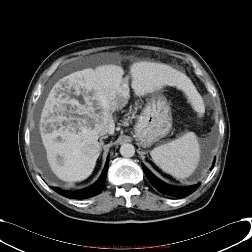 Cirrhosis and hepatocellular carcinoma in the setting of hemochromatosis (Radiopaedia 75394-86595 B 25).jpg