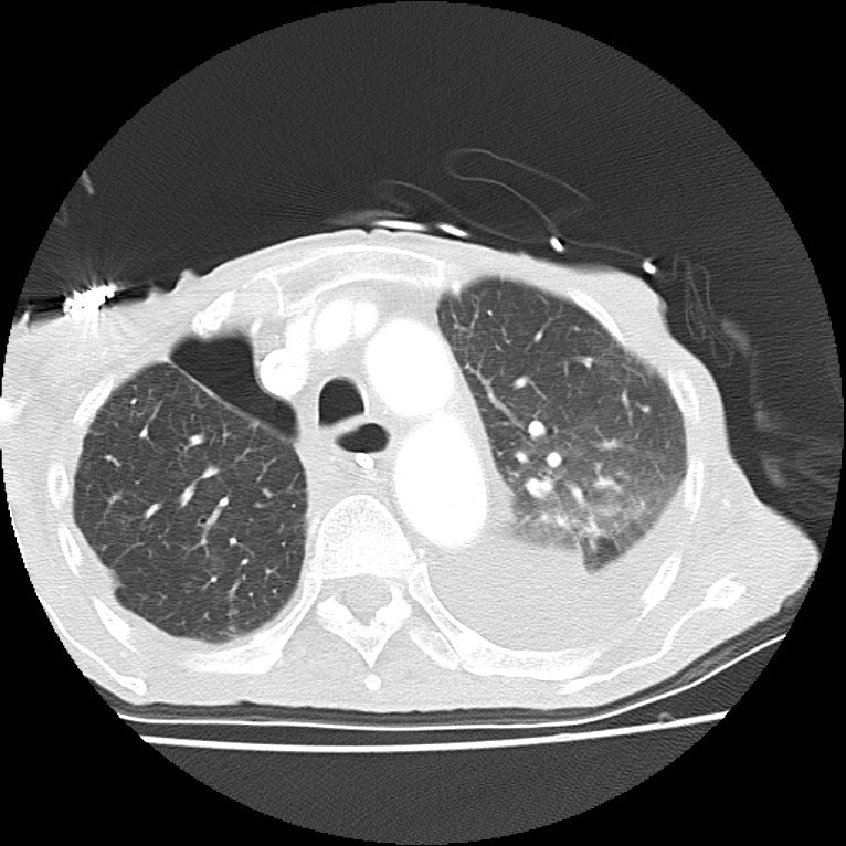 Clagett thoracotomy with bronchopleural fistula (Radiopaedia 29192-29587 Axial lung window 14).jpg