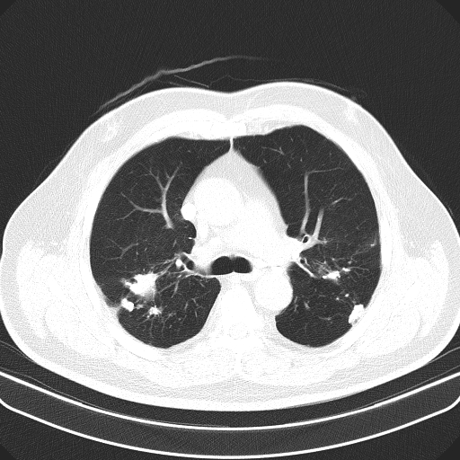 Classic complicated silicosis (Radiopaedia 49720-54961 Axial lung window 21).jpg