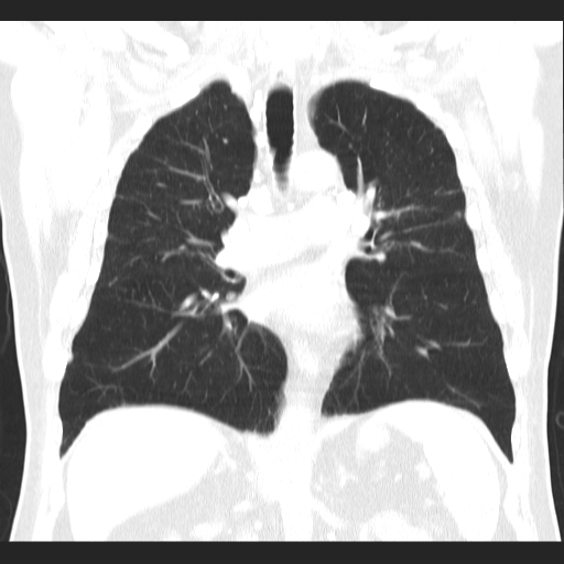 File:Classic complicated silicosis (Radiopaedia 49720-54961 Coronal lung window 33).jpg