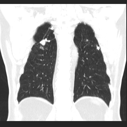 File:Classic complicated silicosis (Radiopaedia 49720-54961 Coronal lung window 49).jpg