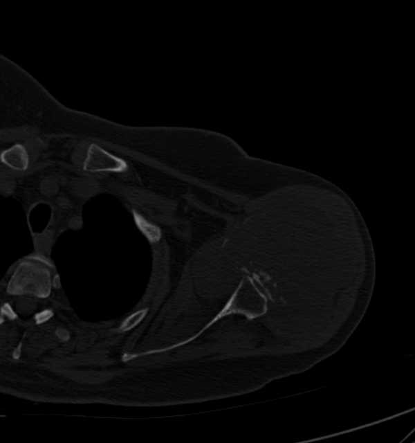 Clear cell chondrosarcoma - humerus (Radiopaedia 63104-71612 Axial bone window 37).jpg