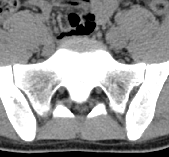 File:Clear cell meningoma - lumbar spine (Radiopaedia 60116-67691 Axial non-contrast 71).png