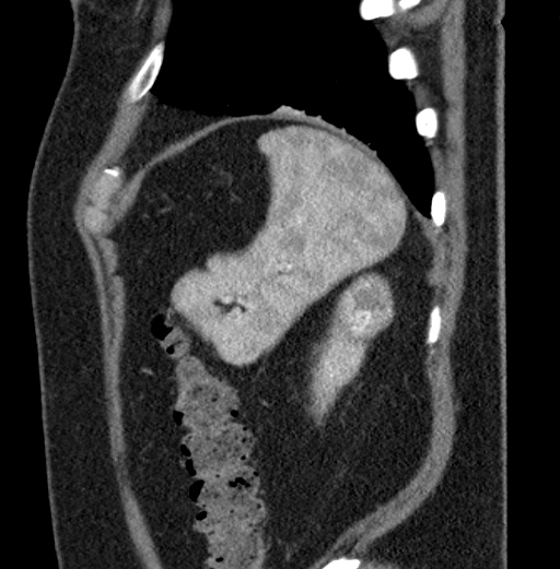File:Clear cell renal cell carcinoma (Radiopaedia 61449-69393 D 6).jpg