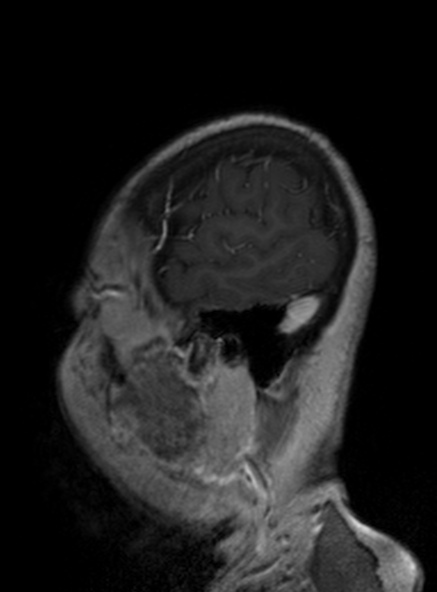 Clival meningioma (Radiopaedia 53278-59248 Sagittal T1 C+ 148).jpg