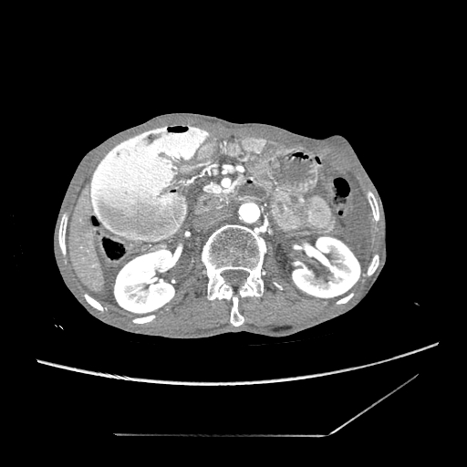 Closed-loop obstruction due to peritoneal seeding mimicking internal hernia after total gastrectomy (Radiopaedia 81897-95864 A 64).jpg
