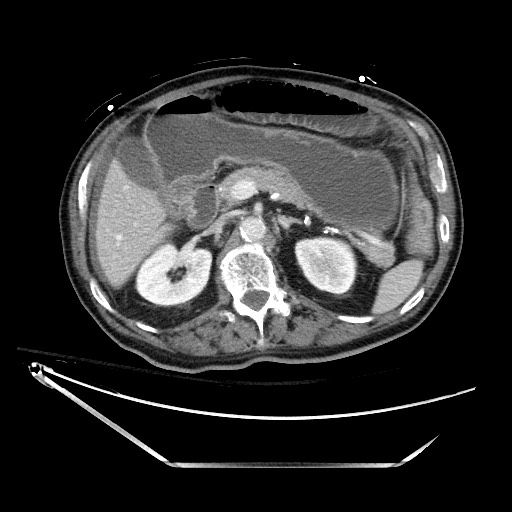 Closed loop obstruction due to adhesive band, resulting in small bowel ischemia and resection (Radiopaedia 83835-99023 D 54).jpg