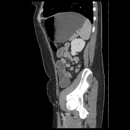Closed loop small bowel obstruction (Radiopaedia 65403-74451 C 83).jpg