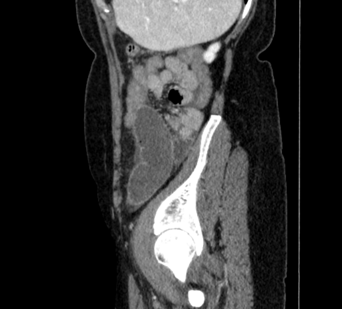 Closed loop small bowel obstruction (Radiopaedia 71211-81508 C 142).jpg