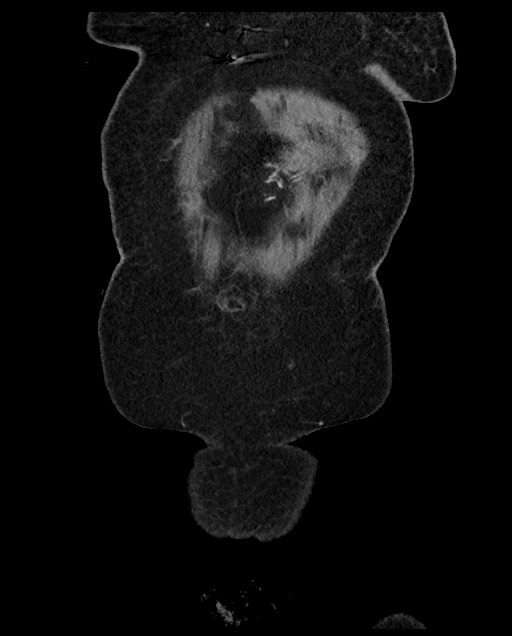 Closed loop small bowel obstruction - adhesions (Radiopaedia 59269-66611 B 14).jpg