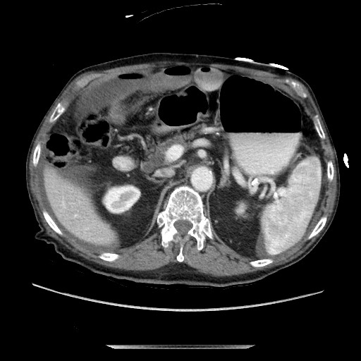 Closed loop small bowel obstruction - adhesive disease and hemorrhagic ischemia (Radiopaedia 86831-102990 A 67).jpg