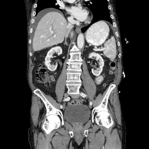 Closed loop small bowel obstruction - adhesive disease and hemorrhagic ischemia (Radiopaedia 86831-102990 B 75).jpg