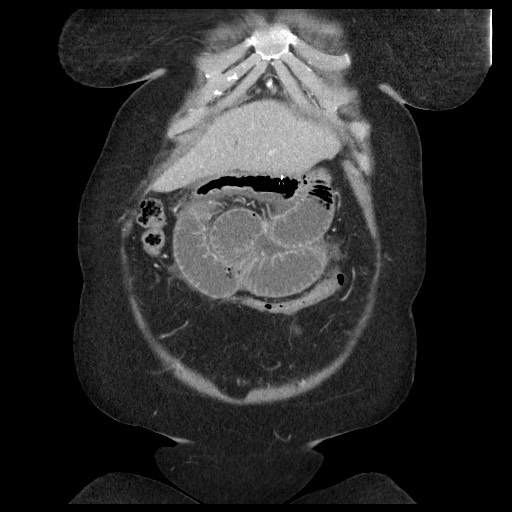 Closed loop small bowel obstruction - internal hernia (Radiopaedia 65402-74450 B 23).jpg