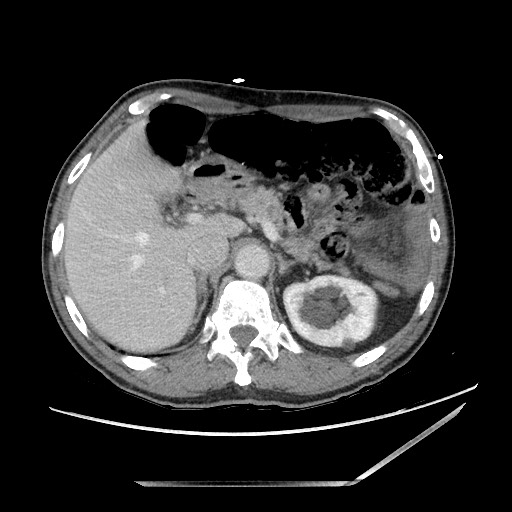 Closed loop small bowel obstruction - omental adhesion causing "internal hernia" (Radiopaedia 85129-100682 A 39).jpg