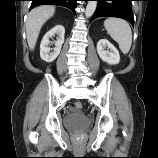 Closed loop small bowel obstruction due to adhesive band - U-shaped loop (Radiopaedia 83829-99012 B 35).jpg