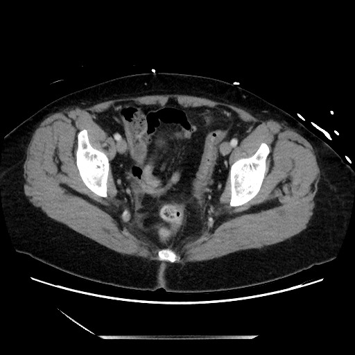 File:Closed loop small bowel obstruction due to adhesive bands - early and late images (Radiopaedia 83830-99014 A 136).jpg