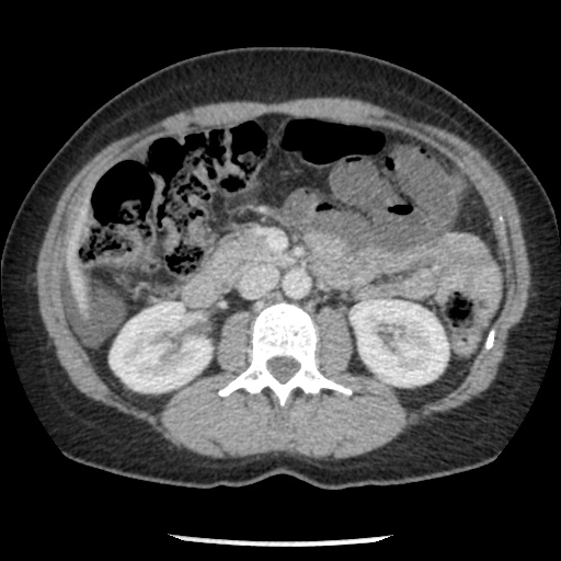 File:Closed loop small bowel obstruction due to trans-omental herniation (Radiopaedia 35593-37109 A 38).jpg