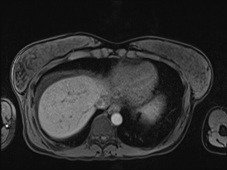 Closed loop small bowel obstruction in pregnancy (MRI) (Radiopaedia 87637-104031 Axial T1 fat sat 13).jpg