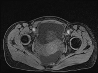 Closed loop small bowel obstruction in pregnancy (MRI) (Radiopaedia 87637-104031 F 62).jpg