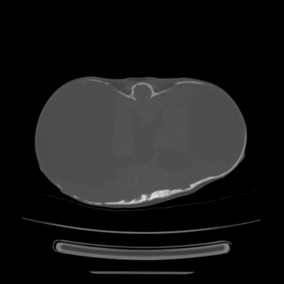 Cloverleaf skull (Radiopaedia 91901-109710 Axial bone window 89).jpg