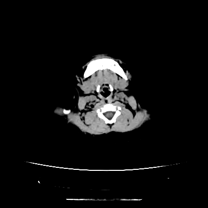 Cloverleaf skull (Radiopaedia 91901-109710 Axial non-contrast 22).jpg