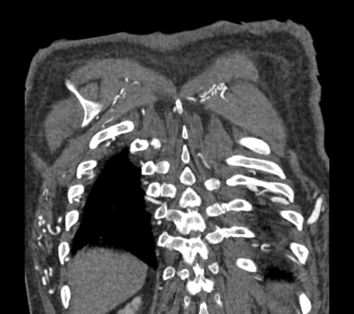 Coarctation of the aorta (Radiopaedia 53752-59822 B 75).jpg