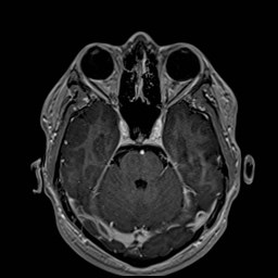Cochlear incomplete partition type III associated with hypothalamic hamartoma (Radiopaedia 88756-105498 Axial T1 C+ 73).jpg