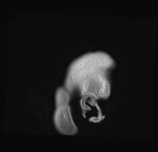 File:Cochlear incomplete partition type III associated with hypothalamic hamartoma (Radiopaedia 88756-105498 Sagittal T1 C+ 1).jpg