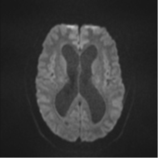 Colloid cyst (Radiopaedia 53164-59125 Axial DWI 43).png