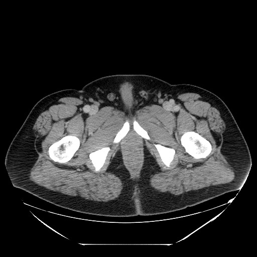 File:Colocolic intussusception due to lipoma (Radiopaedia 73712-84508 Axial 122).jpg