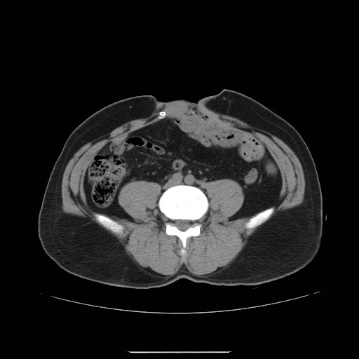 File:Colocutaneous fistula in Crohn's disease (Radiopaedia 29586-30093 Axial non-contrast 1).jpg