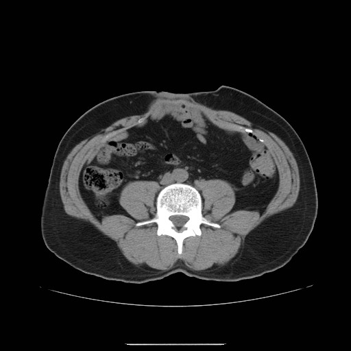 File:Colocutaneous fistula in Crohn's disease (Radiopaedia 29586-30093 Axial non-contrast 14).jpg