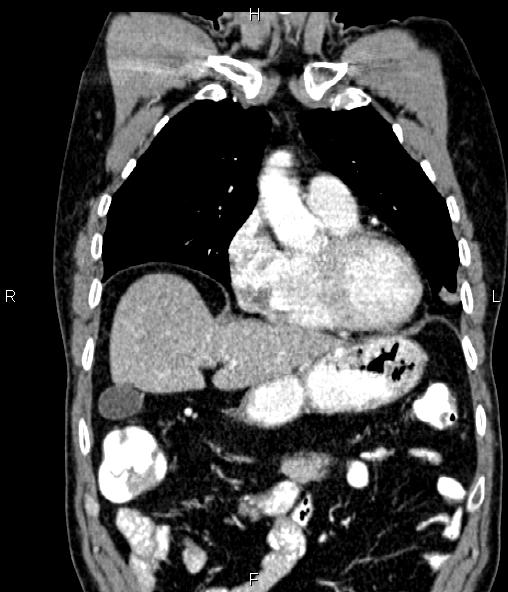 Colon adenocarcinoma (Radiopaedia 83266-97671 C 21).jpg