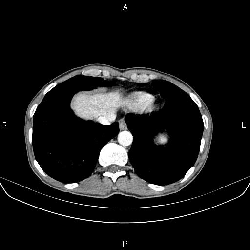 Colon adenocarcinoma - hepatic flexure (Radiopaedia 85635-101395 A 11).jpg