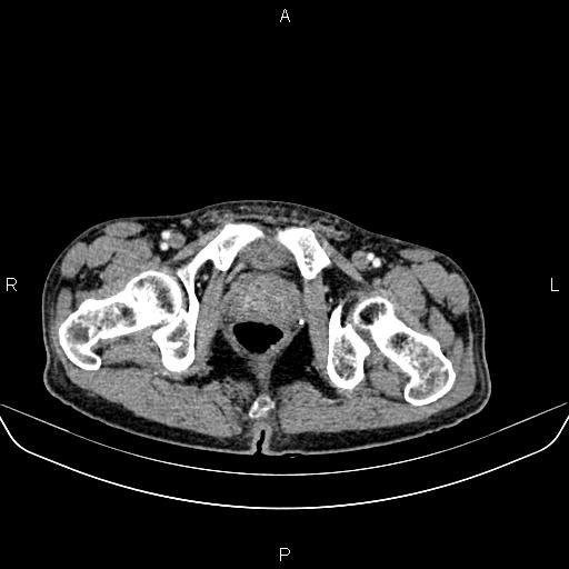 Colon adenocarcinoma - hepatic flexure (Radiopaedia 85635-101395 A 97).jpg