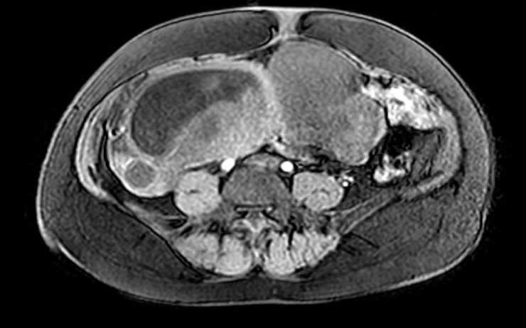 File:Colon adenocarcinoma with Krukenberg tumors, advanced pregnancy (Radiopaedia 67279-76645 A 34).jpg