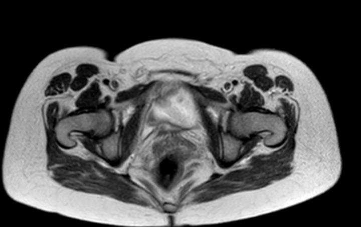 File:Colon adenocarcinoma with Krukenberg tumors, advanced pregnancy (Radiopaedia 67279-76645 Axial T2 5).jpg