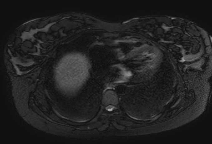 Colon adenocarcinoma with Krukenberg tumors, advanced pregnancy (Radiopaedia 67279-76645 Axial T2 SPAIR 83).jpg