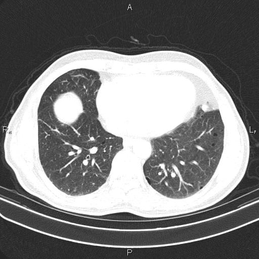 File:Colon cancer (Radiopaedia 85663-101443 Axial lung window 45).jpg