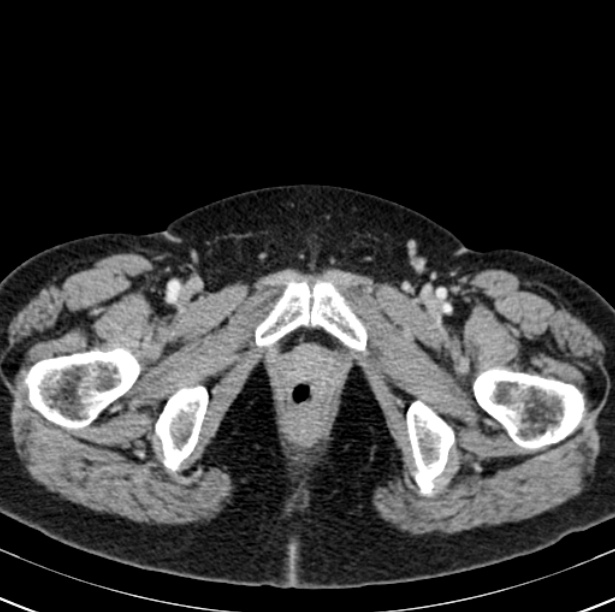 Colon carcinoma with hepatic metastases (Radiopaedia 29477-29961 A 119).jpg
