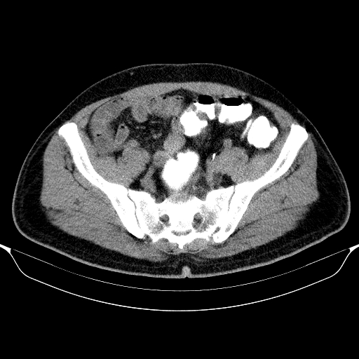 Colonic lipoma with colo-colic intussusception (Radiopaedia 58944-66200 Axial C+ rectal 55).jpg