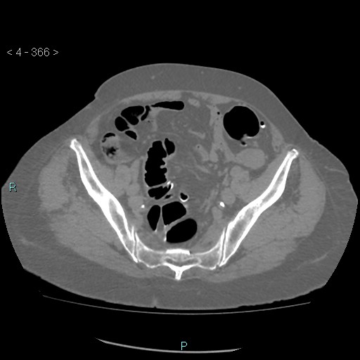Colonic lipomas (Radiopaedia 49137-54244 Axial bone window 164).jpg