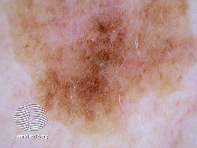 File:Dermoscopy of pigmented actinic keratosis (DermNet NZ pigmented-actinic-keratosis).jpg
