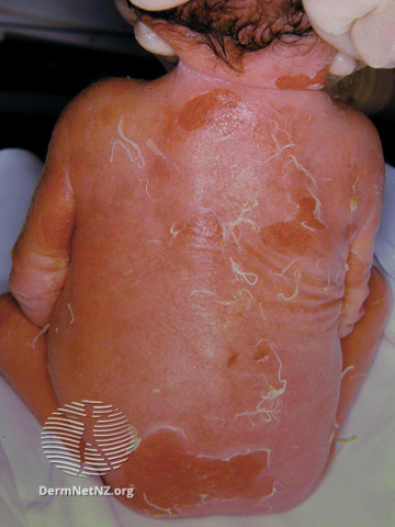 File:Epidermolytic ichthyosis (DermNet NZ scaly-ichthyosis4).jpg