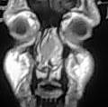 Nasal septum hematoma (Radiopaedia 6778-7968 Coronal T1 1).jpg