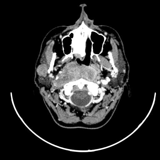 File:Nasopharyngeal carcinoma - infiltrating the clivus (Radiopaedia 62583-70875 Axial Post contrast 20).jpg
