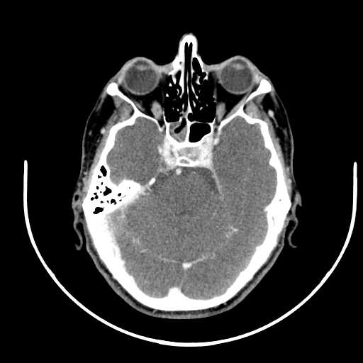 File:Nasopharyngeal carcinoma - infiltrating the clivus (Radiopaedia 62583-70875 Axial Post contrast 5).jpg