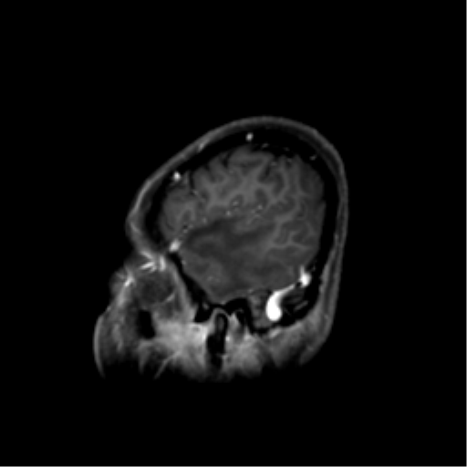 Nasopharyngeal carcinoma with cerebral abscess (Radiopaedia 43018-46274 J 13).png
