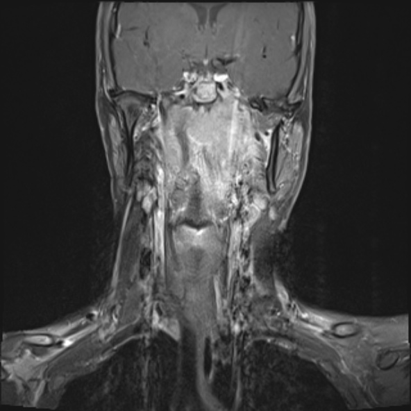 Nasopharyngeal carcinoma with skull base invasion (Radiopaedia 53415-59485 E 18).jpg