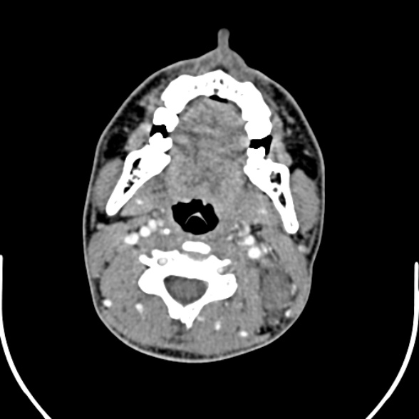 File:Nasopharyngeal carcinoma with skull base invasion (Radiopaedia 53415-59705 A 102).jpg